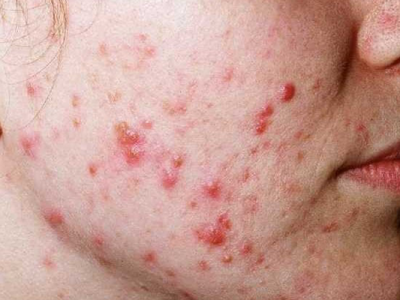 Akne Vulgaris