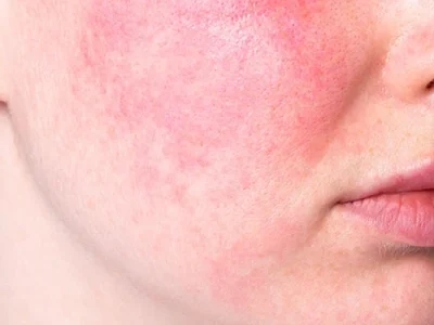 Rosacea Tedavisi